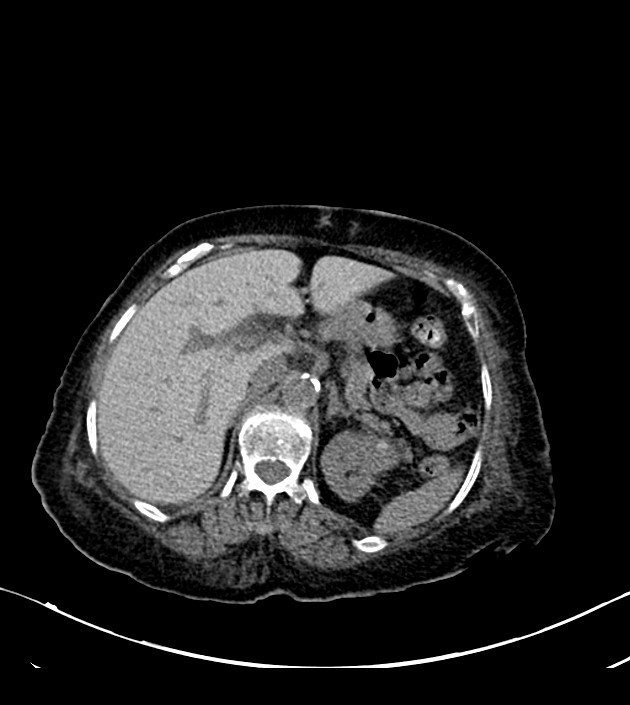 Amiodarone deposition in the liver (Radiopaedia 77587-89780 Axial non-contrast 85).jpg