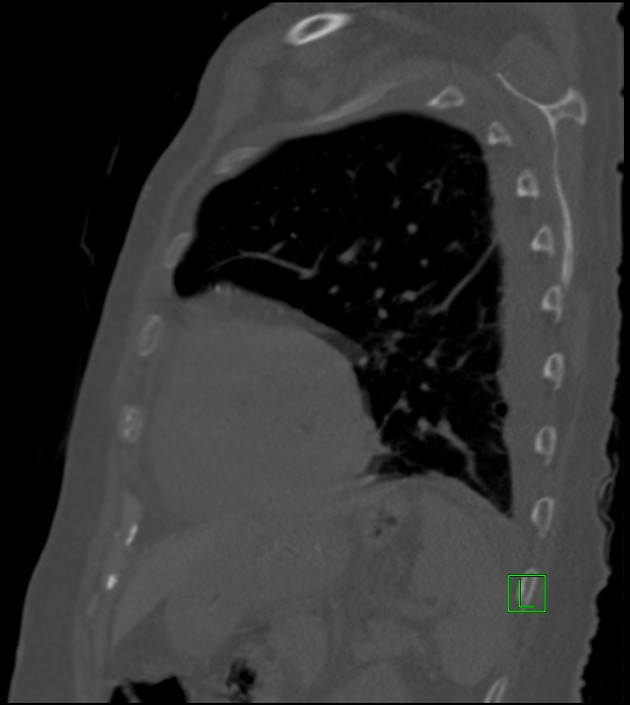 Amiodarone deposition in the liver (Radiopaedia 77587-89780 Sagittal bone window 29).jpg
