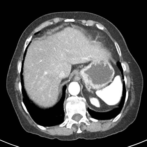 Ampullary adenocarcinoma (Radiopaedia 34013-35237 B 12).png