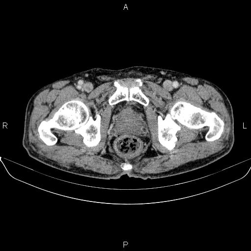 Ampullary adenocarcinoma (Radiopaedia 86093-102032 A 56).jpg