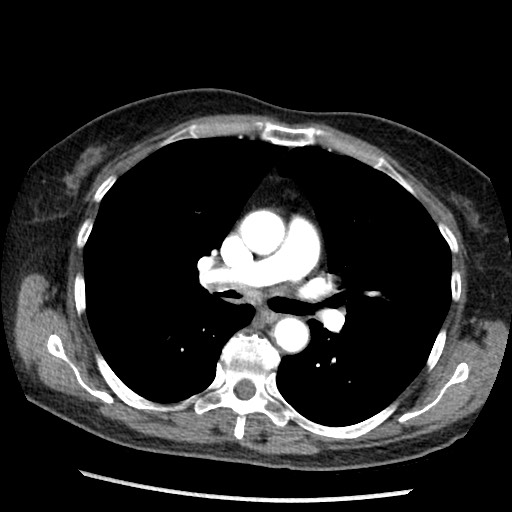 Amyloidosis - bronchial and diffuse nodular pulmonary involvement (Radiopaedia 60156-67745 A 23).jpg