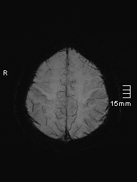 File:Amyotrophic lateral sclerosis (Radiopaedia 70821-81017 Axial SWI minIP 41).jpg