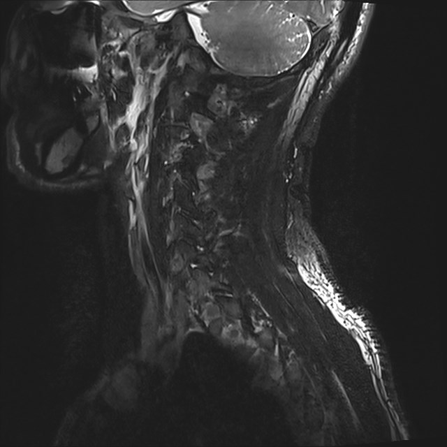 Amyotrophic lateral sclerosis (Radiopaedia 87352-103658 I 2).jpg
