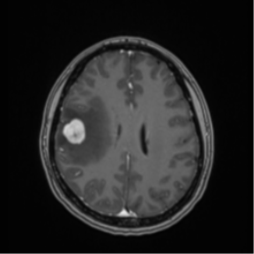 Anaplastic astroblastoma (Radiopaedia 55666-62194 Axial T1 C+ 50).png