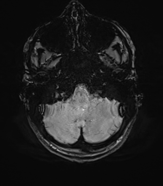 File:Anaplastic astrocytoma IDH mutant (Radiopaedia 50046-55341 Axial SWI 17).png