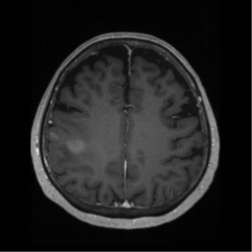 File:Anaplastic astrocytoma IDH wild-type (pseudoprogression) (Radiopaedia 42209-45276 Axial T1 C+ 101).png