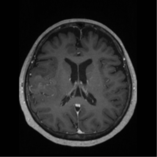 File:Anaplastic astrocytoma IDH wild-type (pseudoprogression) (Radiopaedia 42209-45276 Axial T1 C+ 88).png