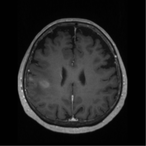 File:Anaplastic astrocytoma IDH wild-type (pseudoprogression) (Radiopaedia 42209-45276 Axial T1 C+ 98).png