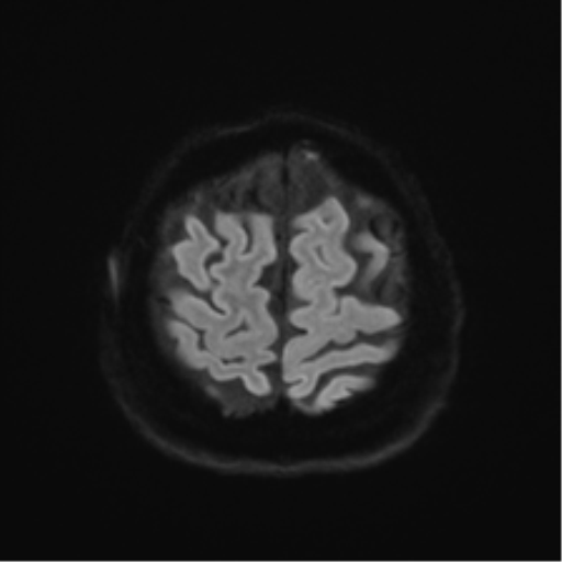 File:Anaplastic astrocytoma IDH wild-type (pseudoprogression) (Radiopaedia 42209-45279 Axial DWI 50).png