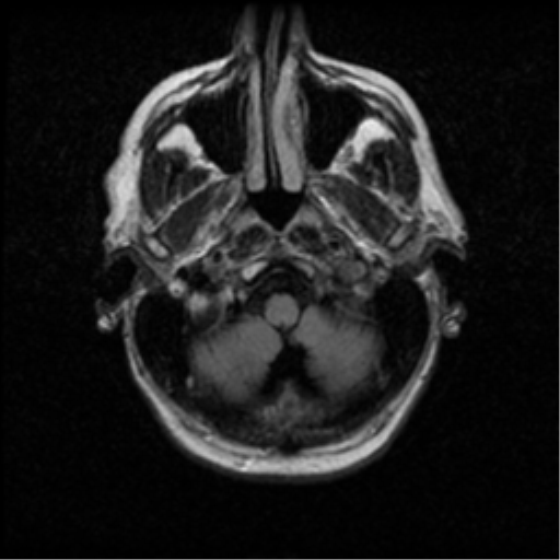 File:Anaplastic meningioma with recurrence (Radiopaedia 34452-35789 Axial FLAIR 3).png