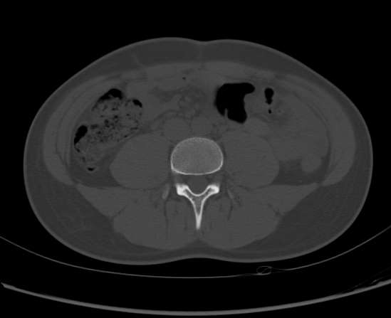 File:Aneurysmal bone cyst of ischium (Radiopaedia 25957-26094 Axial bone window 2).png