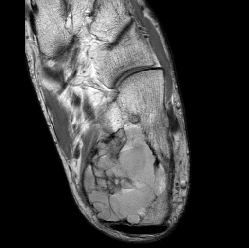File:Aneurysmal bone cyst of the calcaneus (Radiopaedia 60669-68420 Axial PD 11).jpg