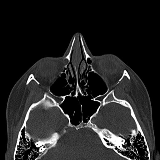 Aneurysmal bone cyst of the mandible (Radiopaedia 43280-46601 Axial bone window 88).jpg