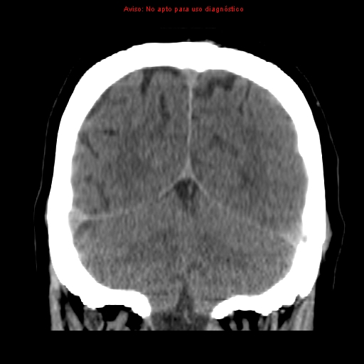 File:Aneurysmal subarachnoid hemorrhage (Radiopaedia 24740-24997 Coronal non-contrast 38).jpg