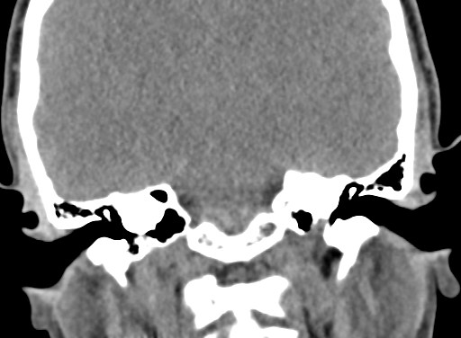 Angular dermoid cyst (Radiopaedia 88967-105790 Coronal non-contrast 74).jpg