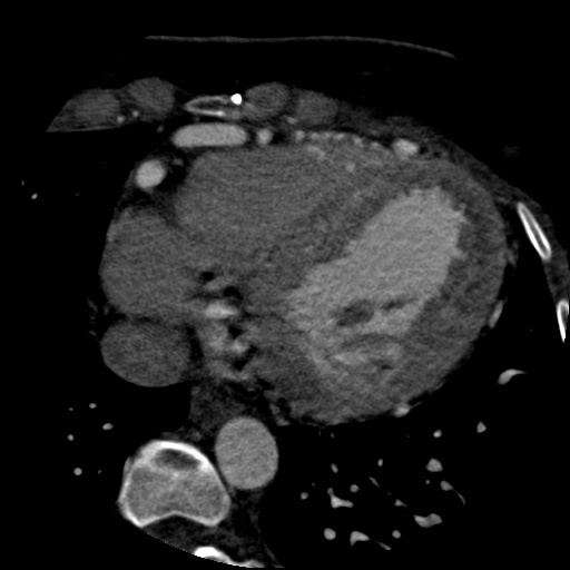 File:Anomalous left coronary artery from the pulmonary artery (ALCAPA) (Radiopaedia 40884-43586 A 63).jpg