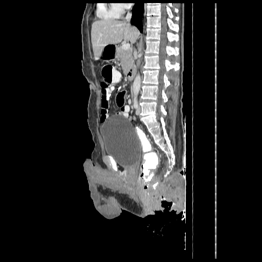 Anorectal carcinoma (Radiopaedia 44413-48064 C 54).jpg