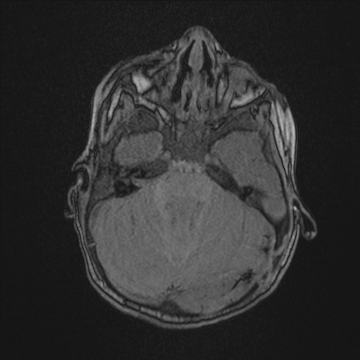 File:Anoxic brain injury (Radiopaedia 79165-92139 Axial MRA 61).jpg