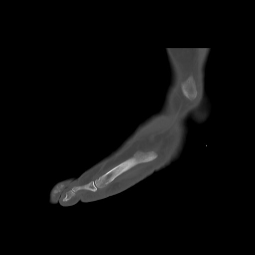 File:Anterior calcaneal process fracture (Radiopaedia 82590-96762 Sagittal bone window 24).jpg