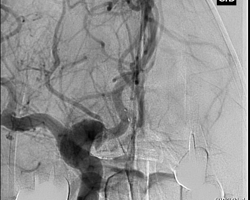 File:Anterior cerebral artery aneurysm (Radiopaedia 80683-94130 A 5).jpg