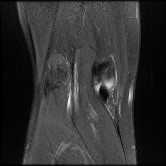 File:Anterior cruciate ligament graft tear and bucket-handle tear of medial meniscus (Radiopaedia 75867-87254 Coronal PD fat sat 21).jpg
