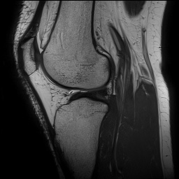 Anterior cruciate ligament rupture and posteromedial corner injury (Radiopaedia 67338-76723 Sagittal PD 105).jpg
