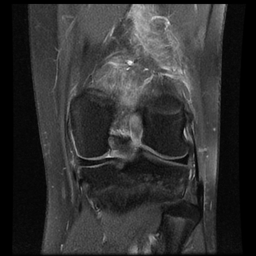File:Anterior cruciate ligament tear (Radiopaedia 61500-69462 Coronal PD fat sat 14).jpg