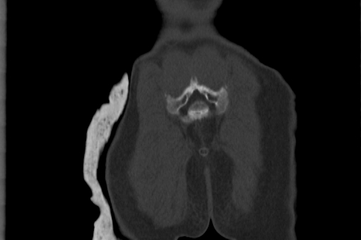Anterior inferior iliac spine avulsion injury (Radiopaedia 88666-105376 Coronal bone window 66).jpg