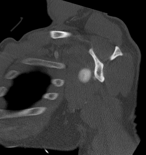 Anterior shoulder dislocation with Hill-Sachs and bony Bankart lesions (Radiopaedia 40424-42974 Sagittal bone window 31).png