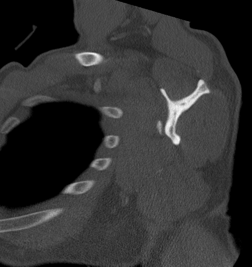 Anterior shoulder dislocation with Hill-Sachs and bony Bankart lesions (Radiopaedia 40424-42974 Sagittal bone window 33).png