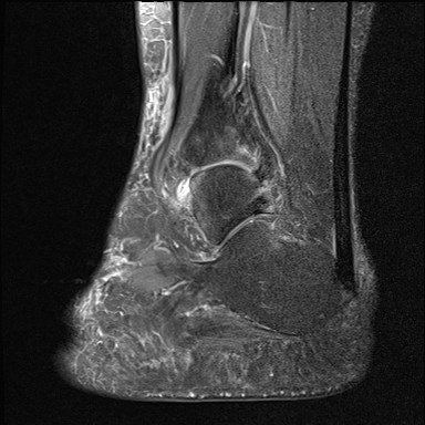 File:Anterior talofibular ligament injury - rupture with soft-tissue impingement (Radiopaedia 38765-40928 Sagittal PD fat sat 15).jpg