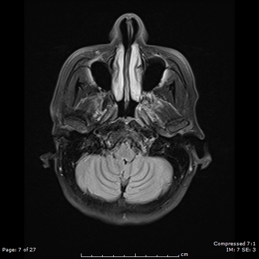 File:Anterior temporal lobe perivascular space (Radiopaedia 88283-104914 Axial FLAIR 7).jpg