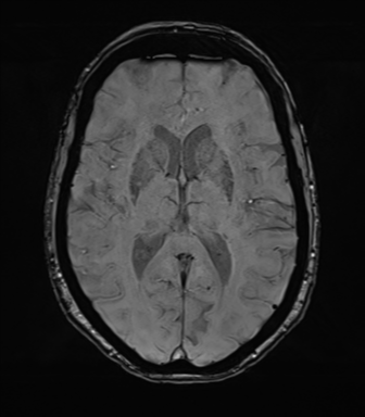 Anterior temporal pole cysts (Radiopaedia 46629-51102 Axial SWI 48).png