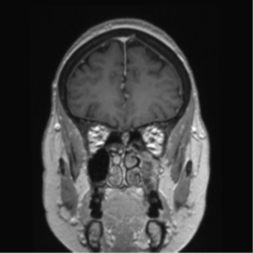 Anterior temporal pole cysts (Radiopaedia 46629-51102 Coronal T1 C+ 132).png
