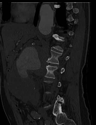 File:Anterior vertebral scalloping (abdominal aortic aneurysm) (Radiopaedia 66744-76067 Sagittal bone window 10).jpg