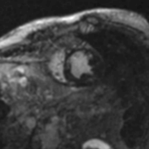 File:Anteroseptal hypokinesia after myocardial infarction (Radiopaedia 15978-15633 I 5).jpg