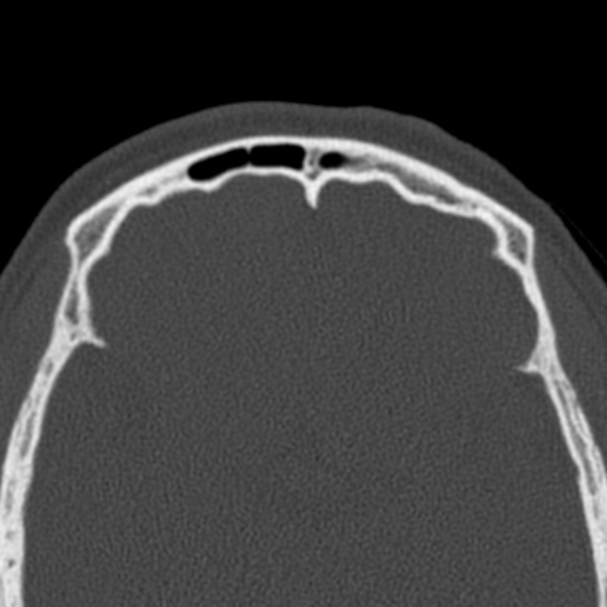 Antrochoanal polyp (Radiopaedia 33984-35202 Axial bone window 75).jpg