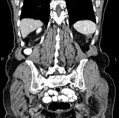 Aortic aneurysm and Lemmel syndrome (Radiopaedia 86499-102554 C 52).jpg