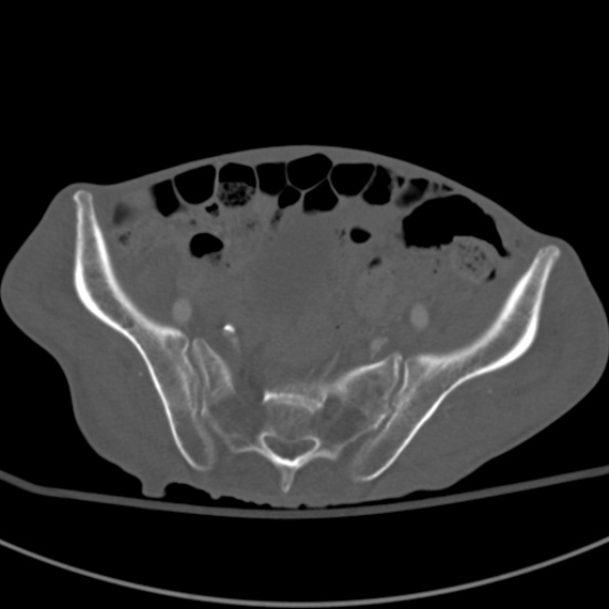 Aortic aneurysm with spinal destruction (Radiopaedia 42301-45410 Axial bone window 85).jpg