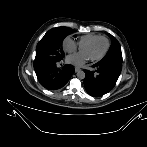 Aortic arch aneurysm (Radiopaedia 84109-99365 Axial non-contrast 168).jpg