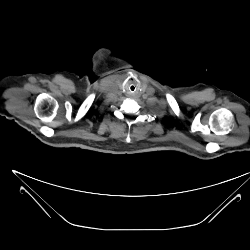 Aortic arch aneurysm (Radiopaedia 84109-99365 Axial non-contrast 8).jpg