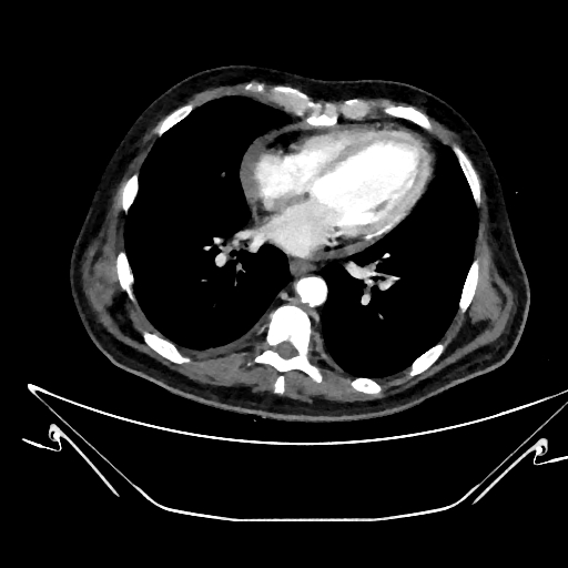 Aortic arch aneurysm (Radiopaedia 84109-99365 C 292).jpg