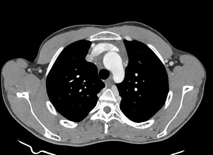 File:Aortic coarctation with aneurysm (Radiopaedia 74818-85828 A 150).jpg