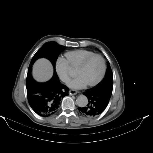 Aortic dissection- Stanford type A (Radiopaedia 22085-22085 Axial C+ delayed 1).jpg