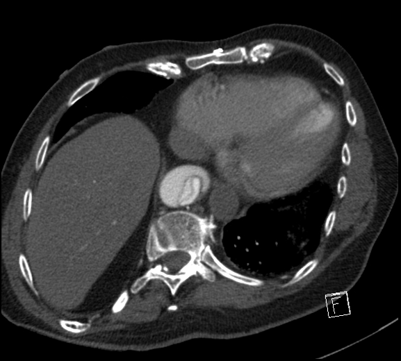 Aortic dissection (CTPA) (Radiopaedia 75506-86750 A 72).jpg