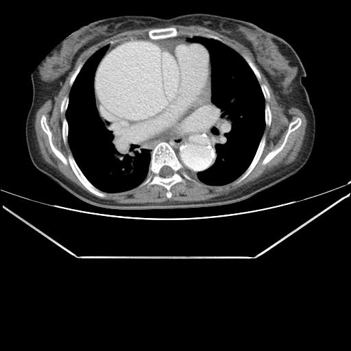 File:Aortic dissection (Radiopaedia 25350-25604 C 23).jpg
