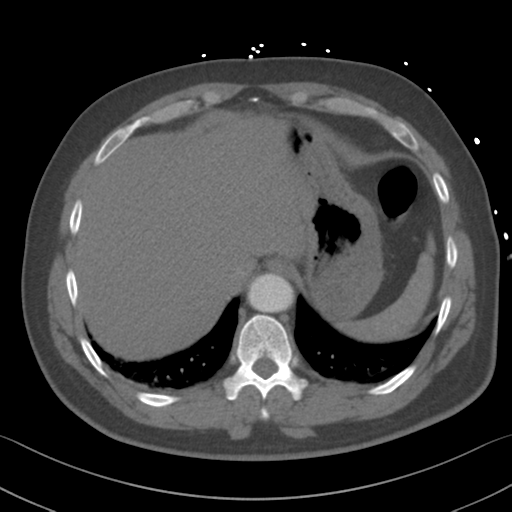 Aortic dissection (Radiopaedia 50763-56234 A 64).png