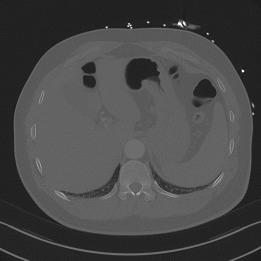 Aortic dissection (Radiopaedia 50763-56234 Axial bone window 93).png