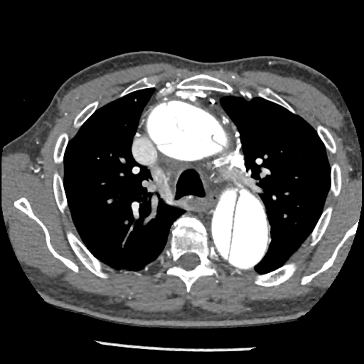 Aortic dissection - DeBakey Type I-Stanford A (Radiopaedia 79863-93115 A 12).jpg