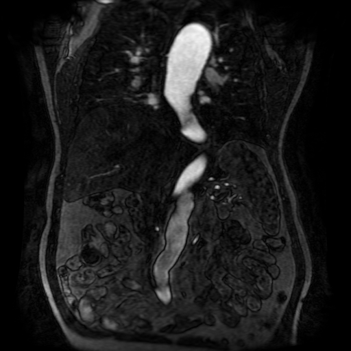 Aortic dissection - Stanford A - DeBakey I (Radiopaedia 23469-23551 D 129).jpg